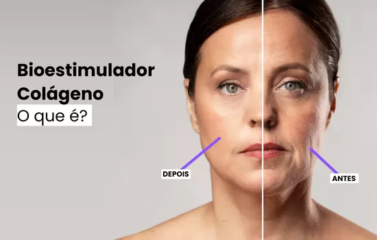 bioestimulador-de-colageno-o-que-e