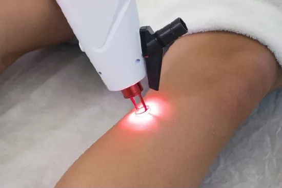 vasinhos-na-perna-como-tratar